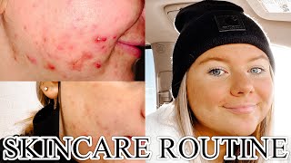 HOW I BEAT MASKNE | My Skincare Routine *Acne Prone Skin*