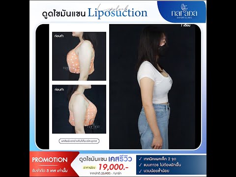 มั่นใจกว่าที่เคย กับต้นแขนที่เรียวเล็กลง การดูดไขมันบริเวณต้นเเขน Lipolock-Liposuction 