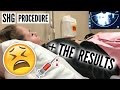 MY SHG PROCEDURE THE RESULTS
