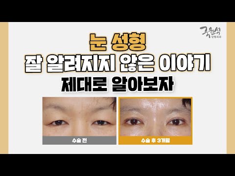 눈 성형에 대해 알려져 있지 않은 사실❗❗❗