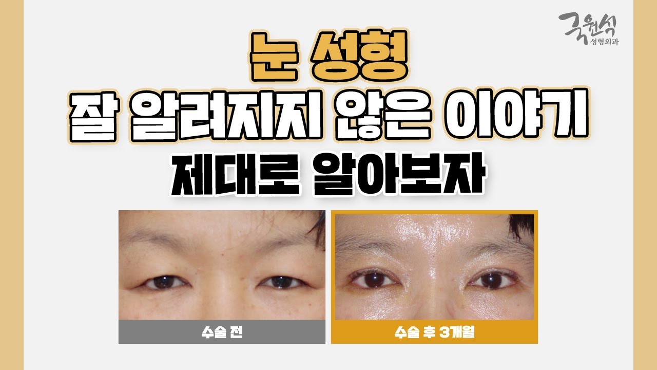 눈 성형에 대해 알려져 있지 않은 사실❗❗❗