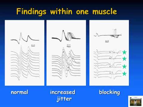 SFEMG - Intro Jitter Measurement  (Don Sanders)