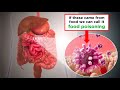 Food Poisoning Shiga Toxin Producing E Coli