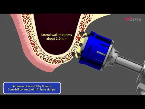 LAS KIT: Lateral Approach - Sinus KIT (Core Drill)