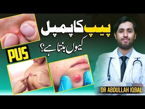 Got Pus-Filled Boils? Discover the 5 Types of Abscess | Simple Pus Ka Ilaj & Peep Wale Danao Ka Ilaj