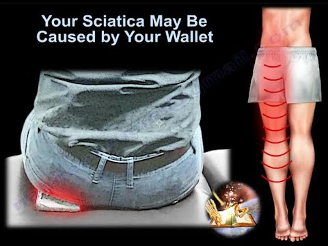 Your Sciatica May Be Caused By Your Wallet  - Everything You Need To Know - Dr. Nabil Ebraheim