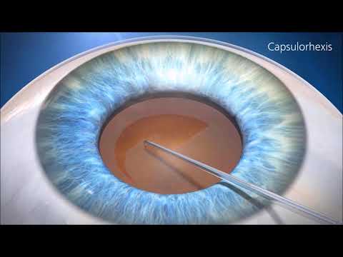 Antrenament pentru ochi pentru îmbunătățirea vederii