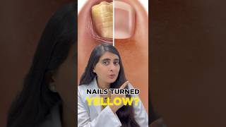 Nail Fungal Infection Treatment | How to get rid of toenail fungus | Nail Fungal infection