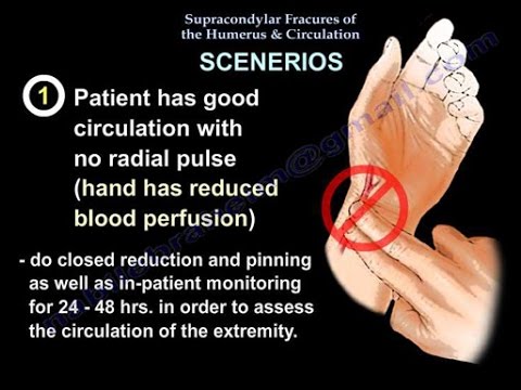 Supracondylar Fracture Humerus & Circulation - Everything You Need To Know - Dr. Nabil Ebraheim