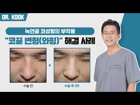 늑연골 코성형 후 와핑으로 인한 코끝 변형, 이렇게 해결할 수 있습니다 ✅