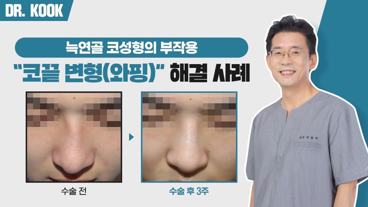 늑연골 코성형 후 와핑으로 인한 코끝 변형, 이렇게 해결할 수 있습니다 ✅ 썸네일