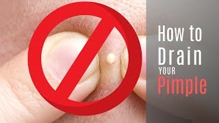 How to Drain Your Pimple to Get Rid of a Popped Pimple Overnight!