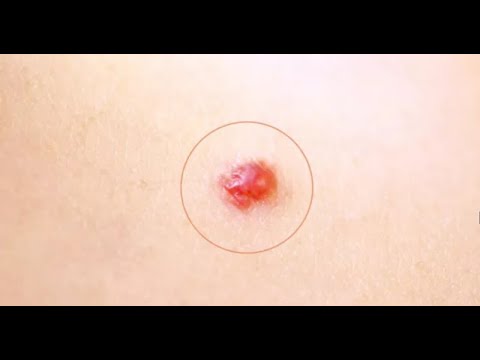Artrosi del trattamento colonna lombare Dolore al collo da fare
