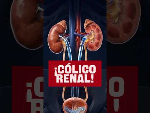 Cólico Renal, ¿sabe usted la causa? #EnfermosRenales #TrasplanteDeÓrganos #Diálisis #LitiasisRenal