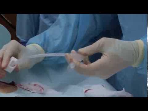 Initial Placement of the EndoVive™ Safety Percutaneous Endoscopic Gastrostomy (PEG) Tube