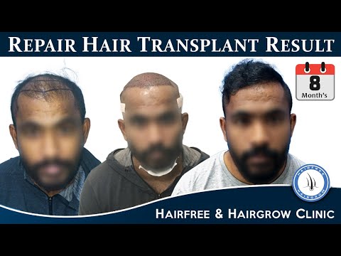 Repair Hair Transplant Result After 8 Months | Hair Transplant Before and After Result | HFHG CLINIC