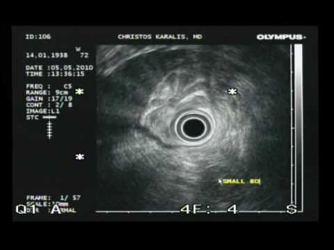 Chronic Inflamation Of A Pancreas - Ultrasound Endoscopy