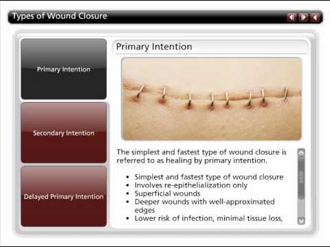 Types of Wound Closure