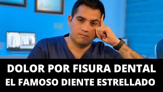 Dolor dental por fisura el famoso diente estrellado