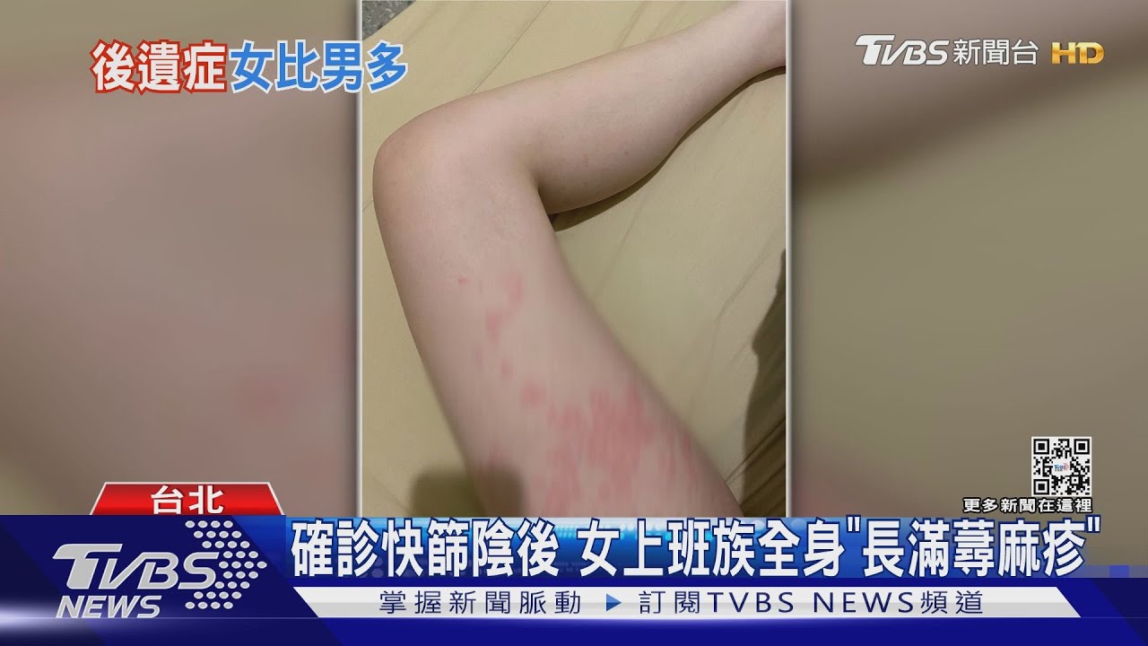 確診快篩陰後 女上班族全身「長滿蕁麻疹」