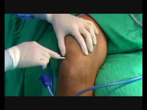 Arthroscopic Cleanup In Joint Septic Inflammation