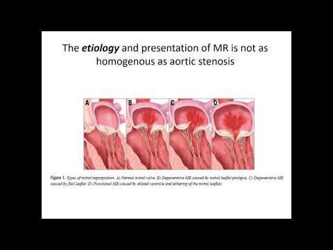 Unlike TAVR, TMVR will probably not replace surgical MVR in the near future