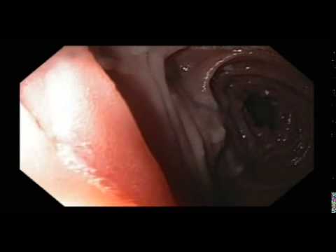 Yeyuno, neoplasias benignas, adenomas tubulares con displasia