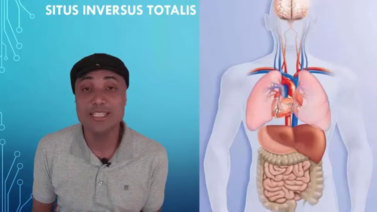 Coração do Lado Direito - Dextrocardia. Órgãos Invertidos (Situs Inversus Totalis )