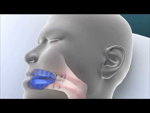 Anti-snurk mondstuk - Hoe werkt het Feazy.be