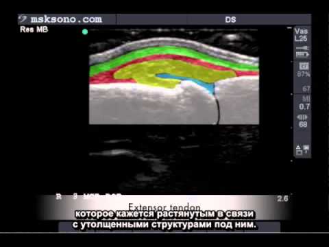 3 недели беременности болит поясница Узи сосудов и мрт сосудов шейного отдела позвоночника