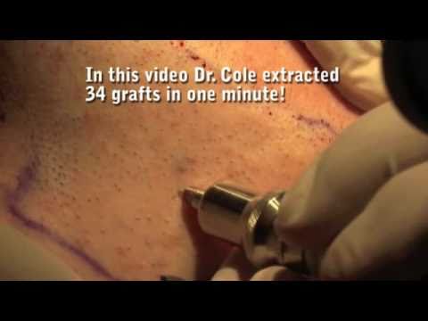 Groundbreaking Developments for FUE Hair Transplant By...