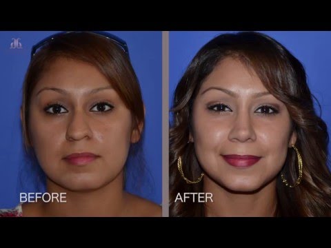 Plastic Surgery Miracle - Rhinoplasty Patient Experience by Dr. Ghavami