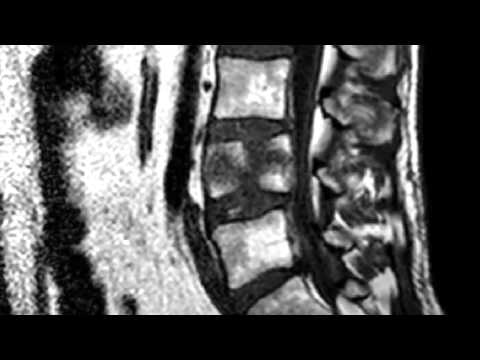 Spinal expert breaks spine in crash