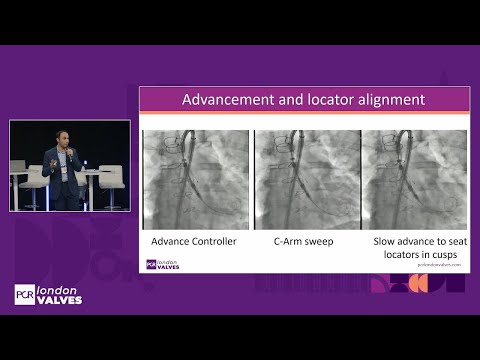 New era for aortic regurgitation: how new guidelines & AR-dedicated devices will redefine treatment