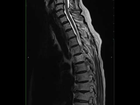 Rafforzare i muscoli della colonna vertebrale del rachide cervicale Il mal di schiena dopo un massaggio tailandese