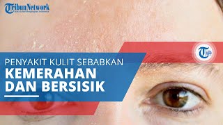 Dermatitis Seboroik, Penyakit yang Menyebabkan Kulit Berwarna Merah, Berketombe, dan Bersisik