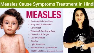 Measles/Rubeola Cause Symptom Treatment Hindi | What is Measles | Measles Treatment | Measles Cause,