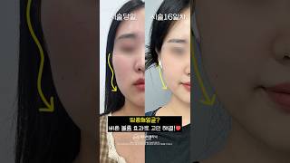 울퉁불퉁 땅콩형 얼굴 개선 비법