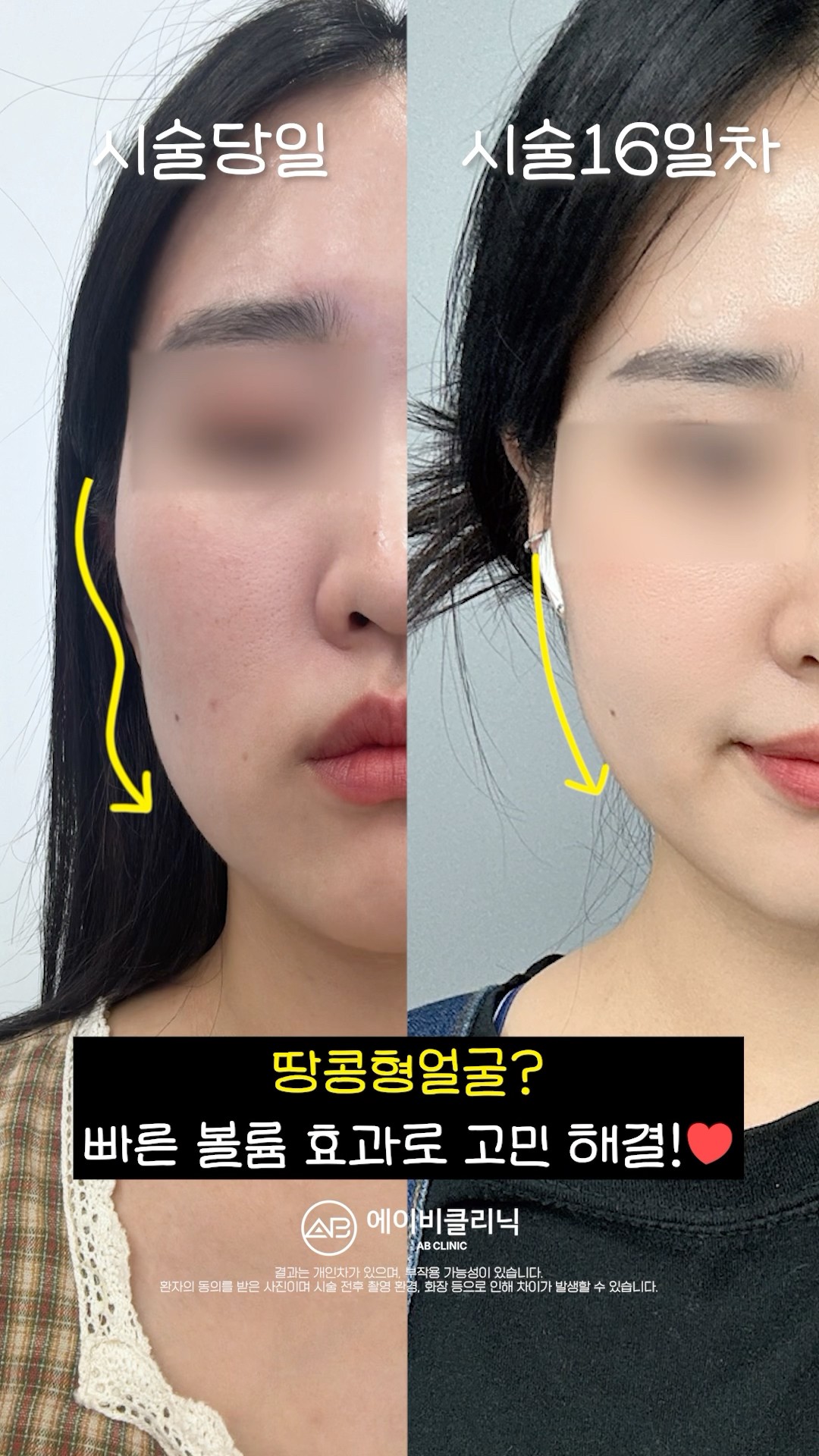 울퉁불퉁 땅콩형 얼굴 개선 비법