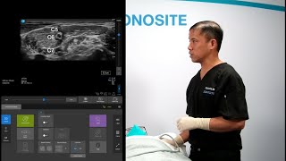 The Power of Sonosite Systems for Ultrasound Guided Regional Nerve Blocks