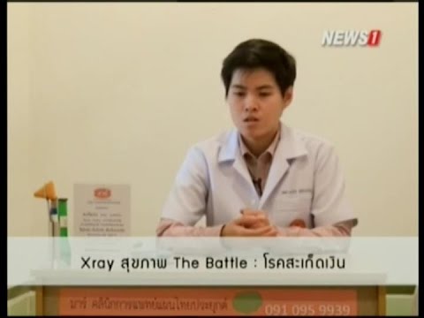 Pediculosis และโรคผิวหนังภูมิแพ้ กลากพื้นบ้านครีมสมุนไพร