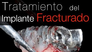Implante Dental Roto: Causas y Opciones de Tratamiento del implante fracturado - Primera parte! 1/2