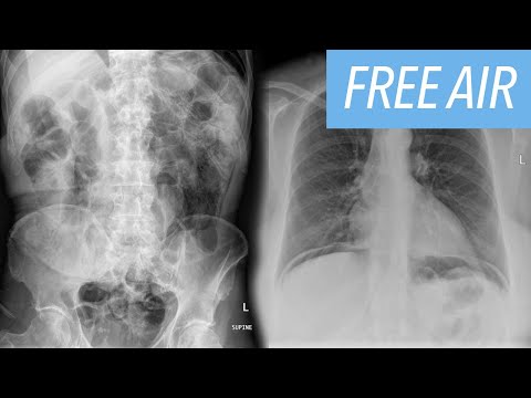 Radiographic Signs of Pneumoperitoneum