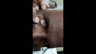 SEVERE ANEMIA - short physical examination,IRON DEFICIENCY ANEMIA,NUTRITIONAL ANEMIA