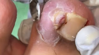 Ep_8697 Ingrown toenail removal 👣 น้องควรแช่น้ำ..อาทิตย์ละครั้ง 😅 (clip from Thailand)