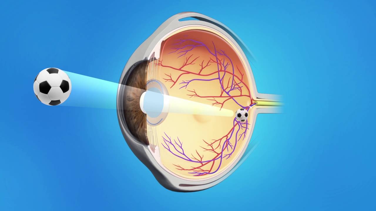 Cataract Phaco with Multifocal Lens
