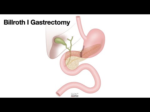 HCC 1475-10b-Surgical Anatomy-Billroth I