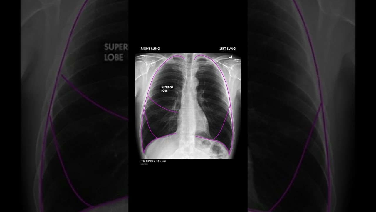 Lung Anatomy on a Chest X-Ray - Shorts