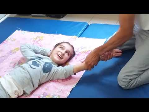 Спастический тетрапарез ДЦП cerebral palsy