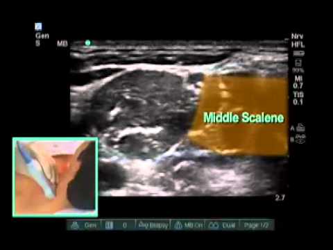 How To: Ultrasound-Guided Interscalene Block Scanning Technique Video